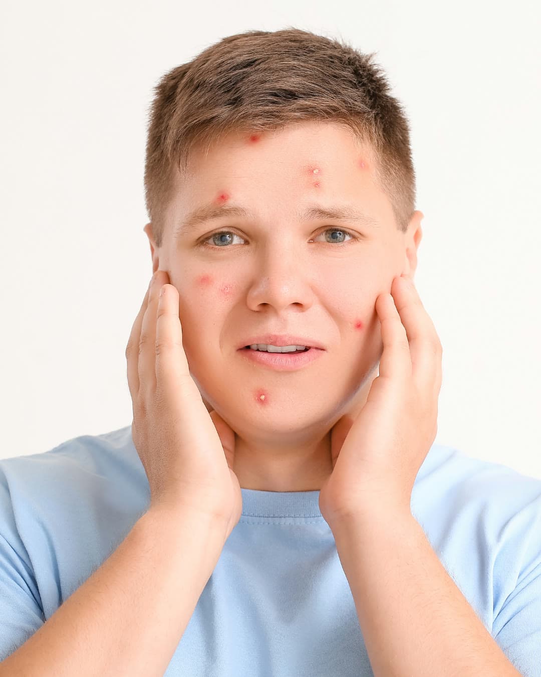Acne concern — Dr Alexa aesthetic clinic London