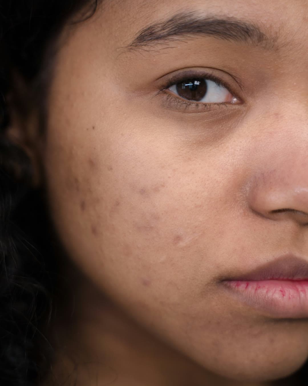 Acne Scarring treatment at Dr Alexa, Mayfair London