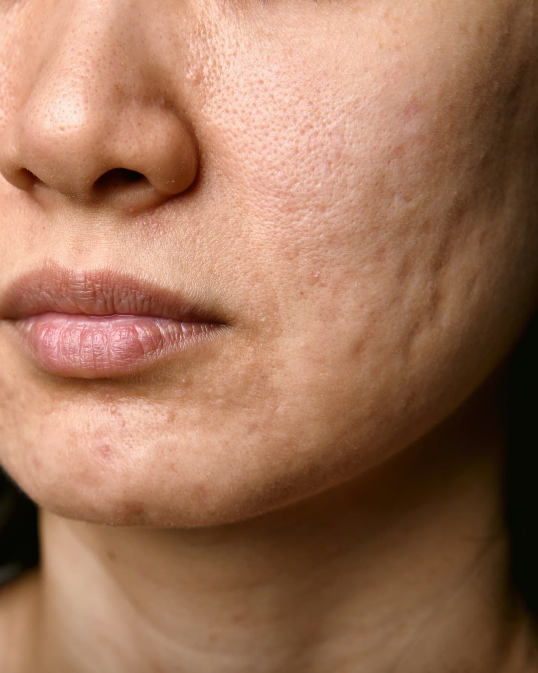 Acne Scarring concern — Dr Alexa aesthetic clinic London
