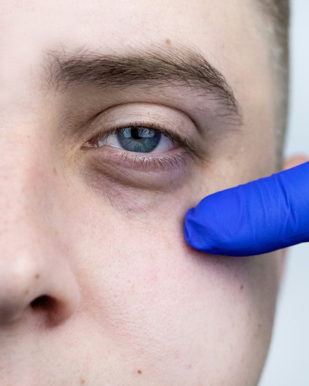 Dark Circles / Eye Bags treatment at Dr Alexa, Mayfair London