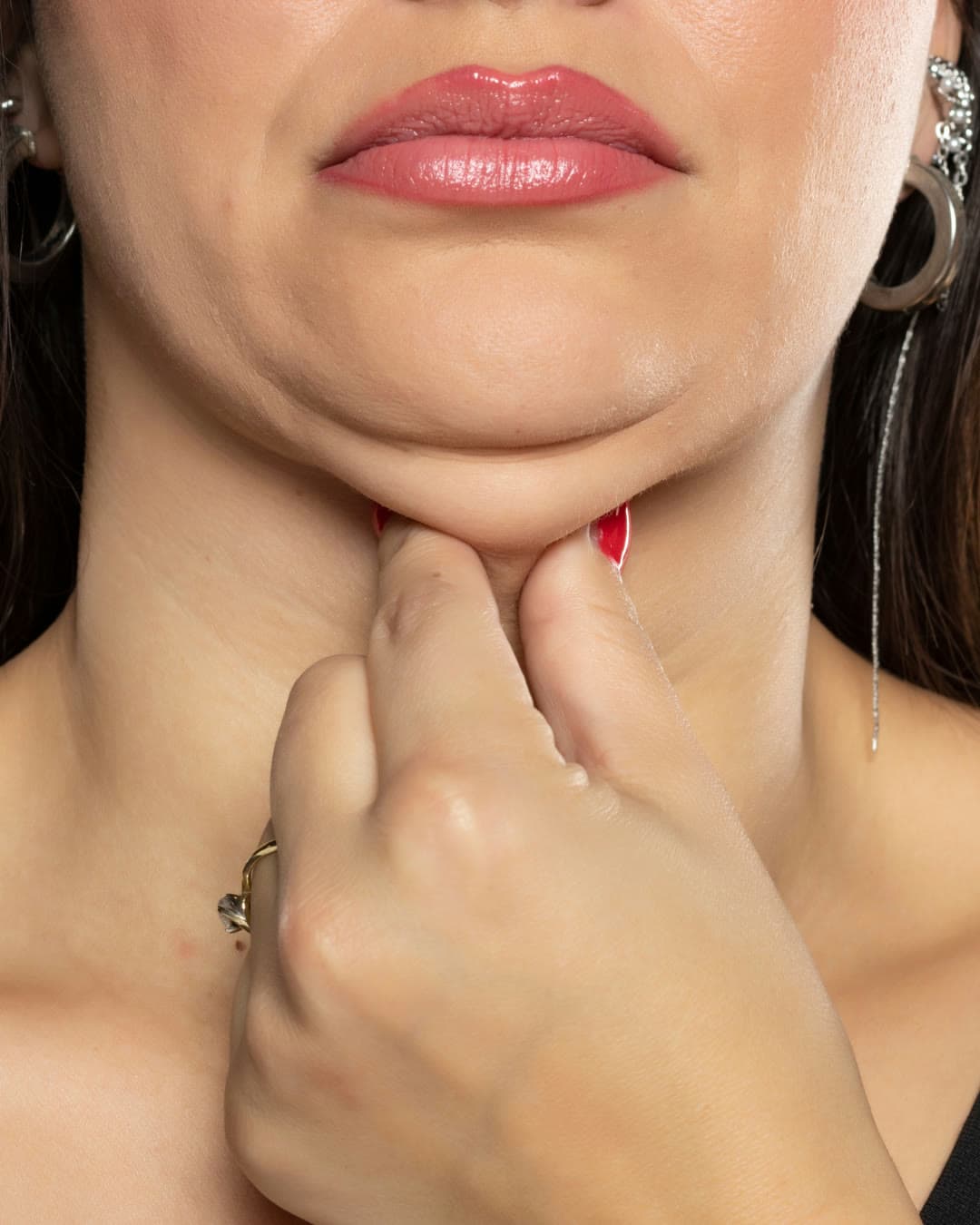 Double Chin treatment at Dr Alexa, Mayfair London