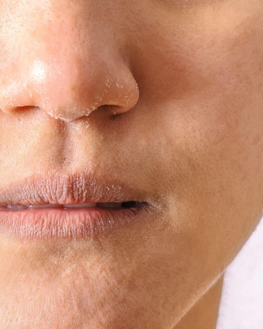 Dry or Dehydrated Skin treatment at Dr Alexa, Mayfair London