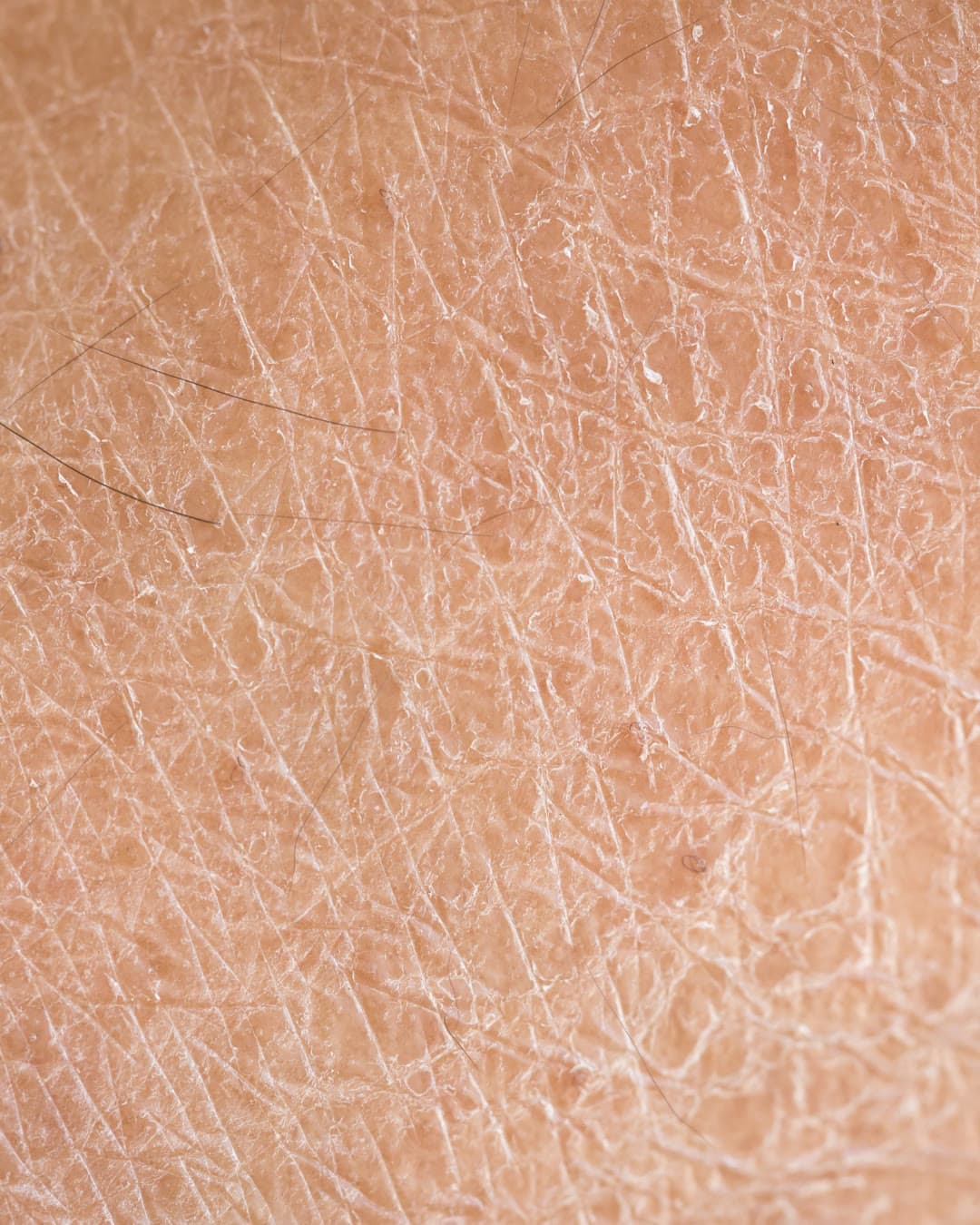Dry or Dehydrated Skin concern — Dr Alexa aesthetic clinic London