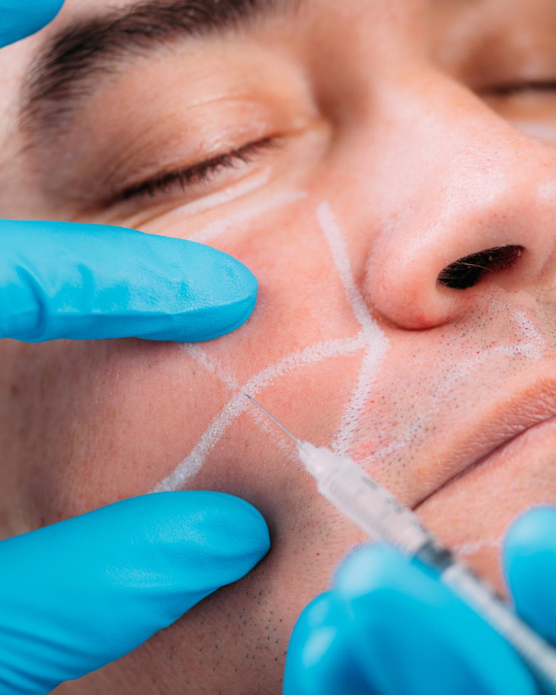 Flattened Cheeks treatment at Dr Alexa, Mayfair London