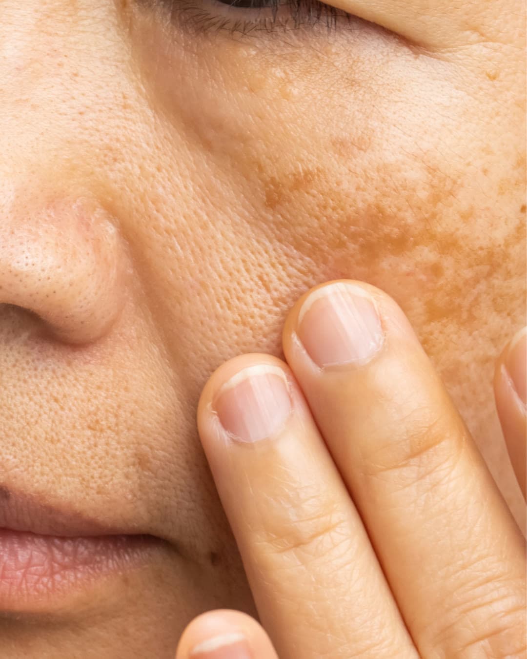 Flattened Cheeks concern — Dr Alexa aesthetic clinic London