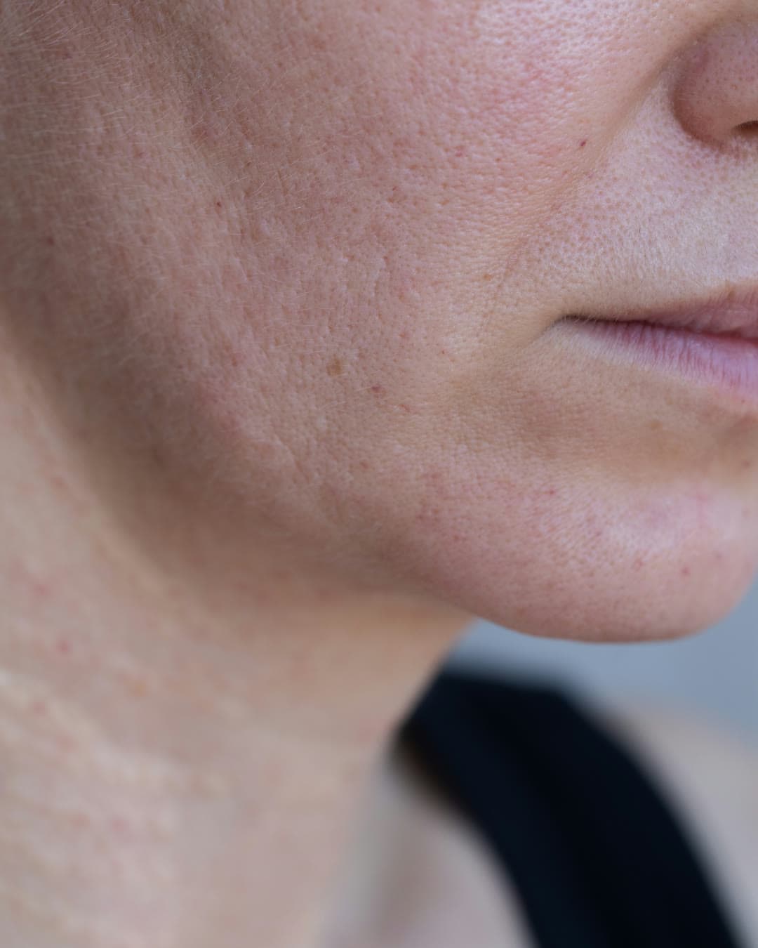 Sagging Jowls treatment at Dr Alexa, Mayfair London