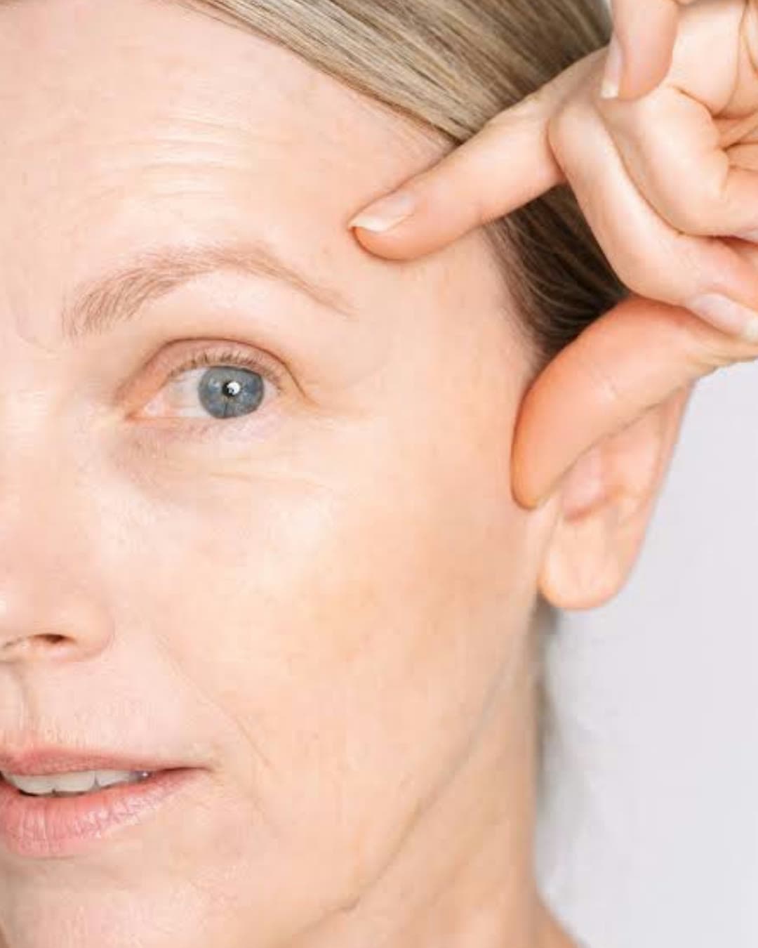 Temple Hollowing concern — Dr Alexa aesthetic clinic London