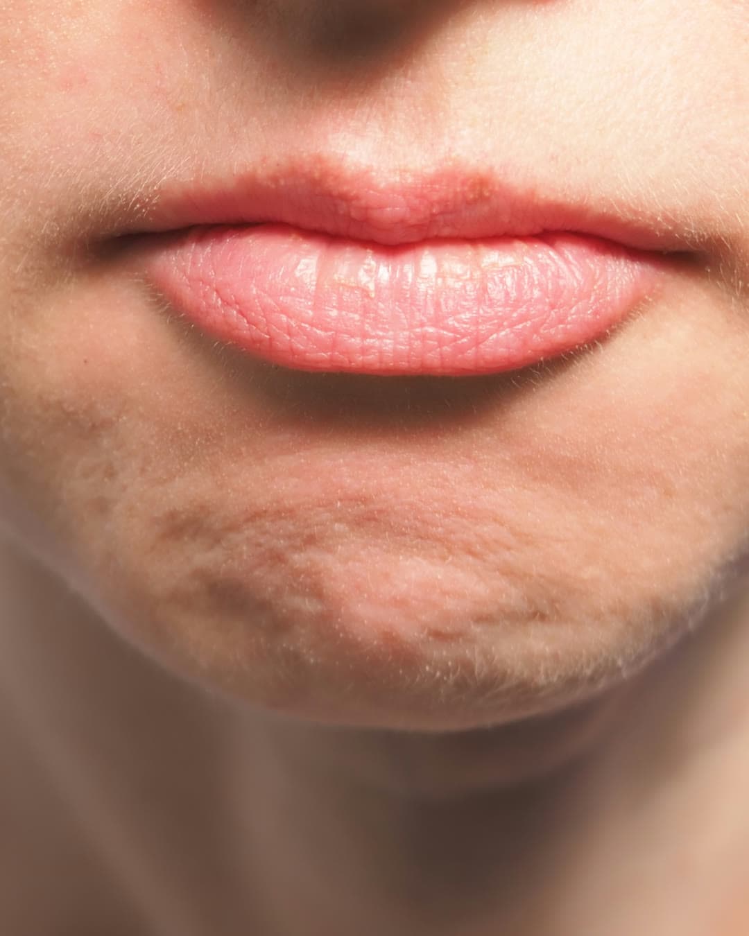 Weak Chin treatment at Dr Alexa, Mayfair London