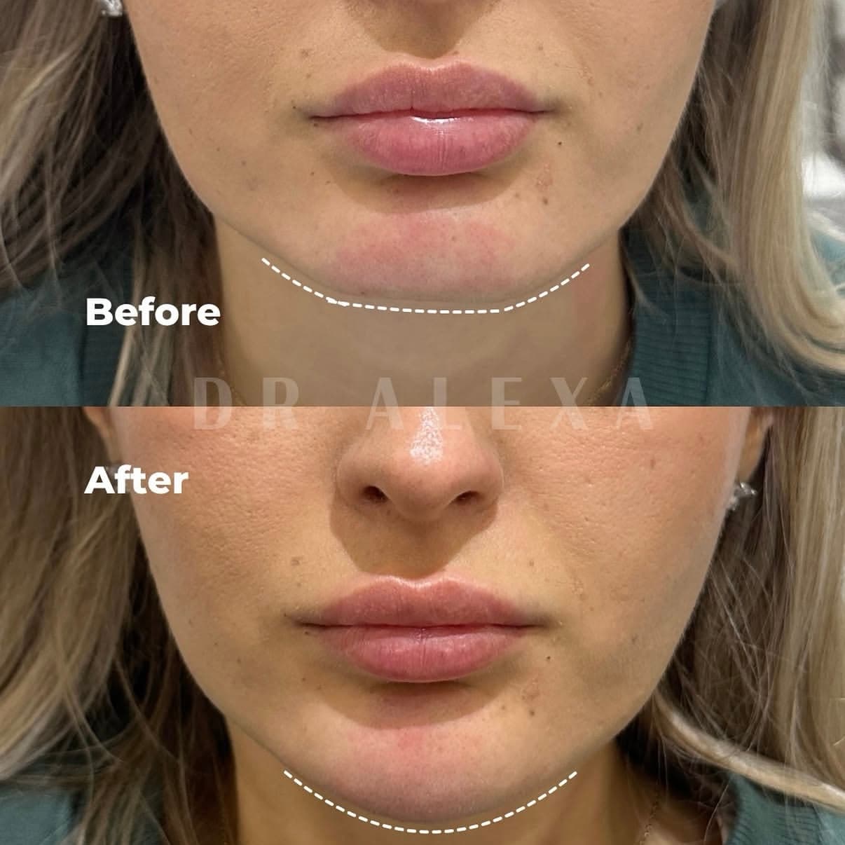 Dr Alexa Instagram post 1 — aesthetic clinic Mayfair London