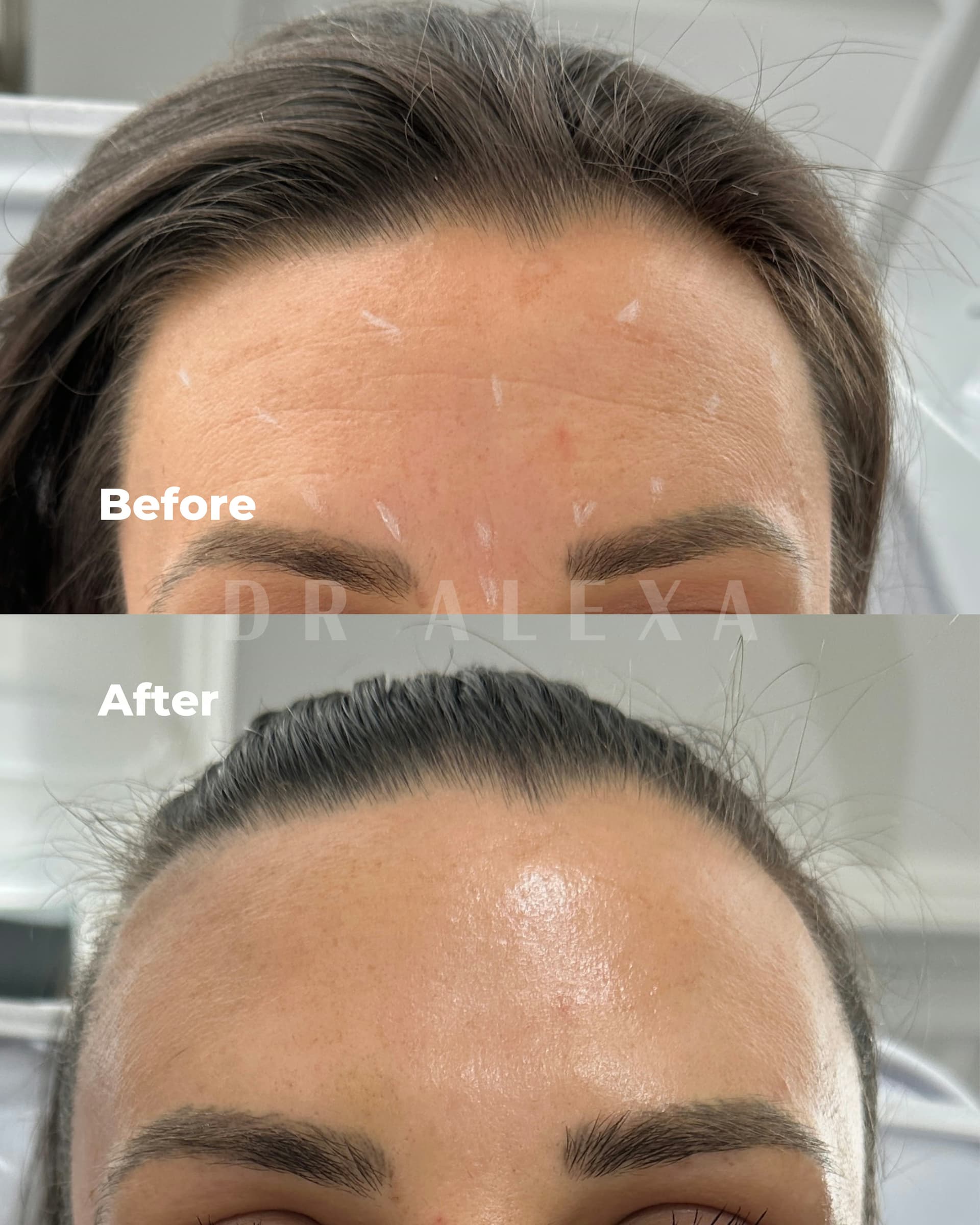 Anti-Wrinkle Injections before and after — case 1, Dr Alexa Mayfair