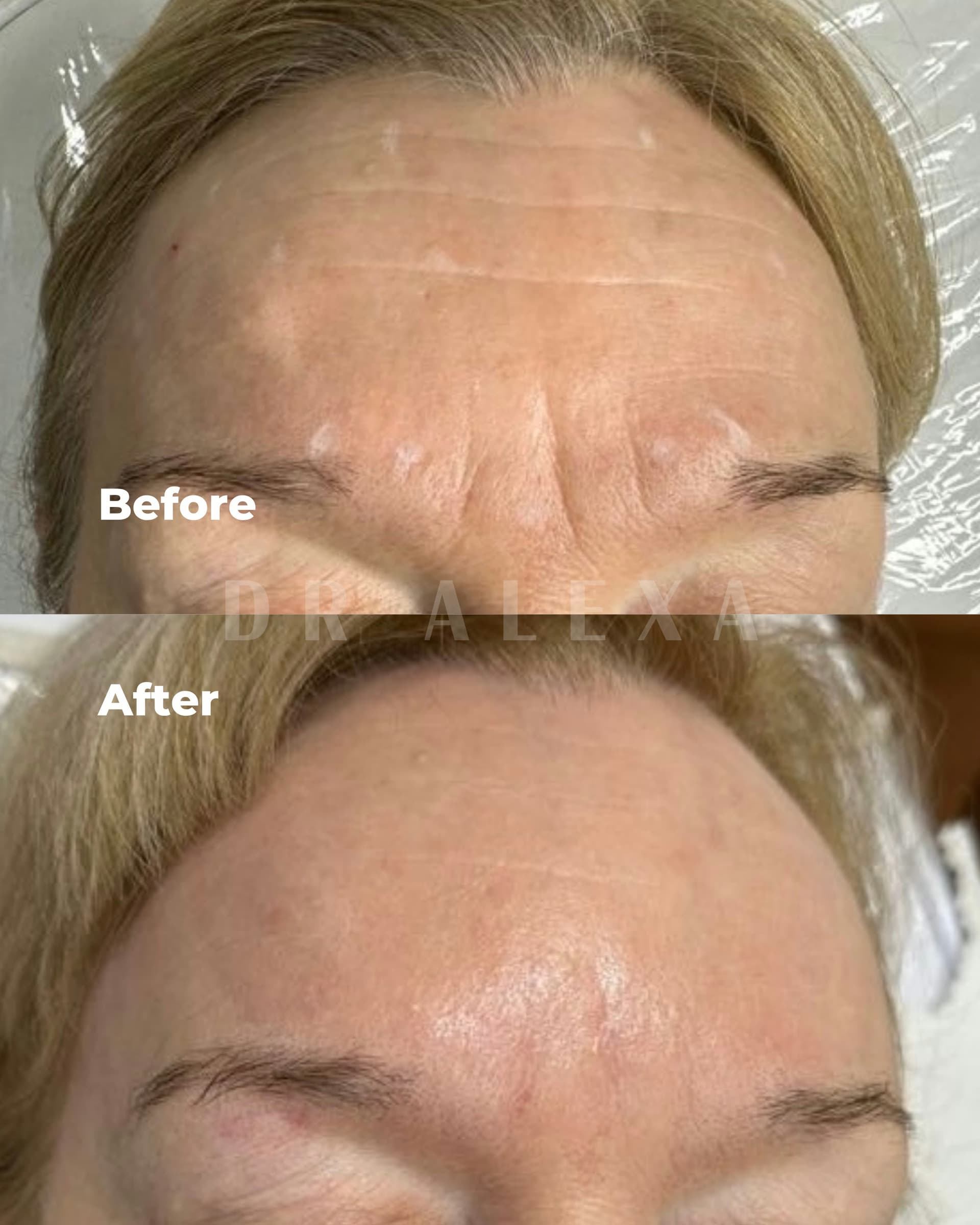 Anti-Wrinkle Injections before and after — case 2, Dr Alexa Mayfair