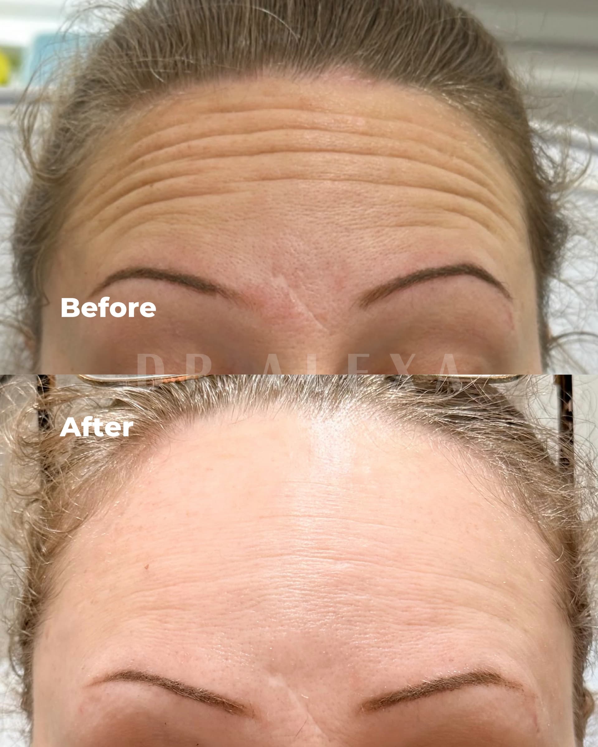 Anti-Wrinkle Injections before and after — case 3, Dr Alexa Mayfair