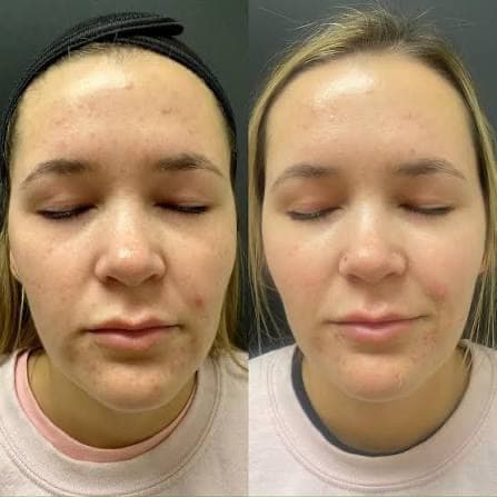 BioRePeel before and after — case 1, Dr Alexa Mayfair