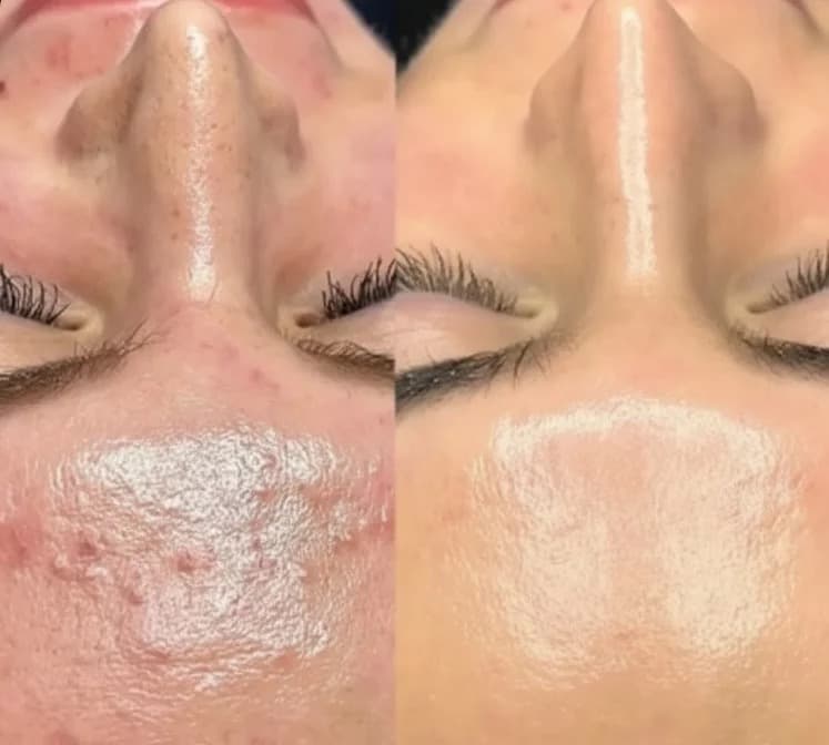 BioRePeel before and after — case 2, Dr Alexa Mayfair