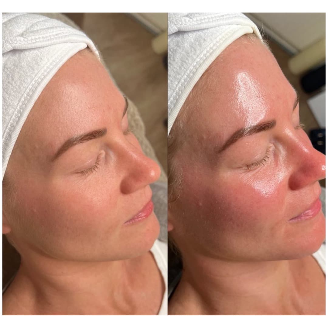 BioRePeel before and after — case 3, Dr Alexa Mayfair