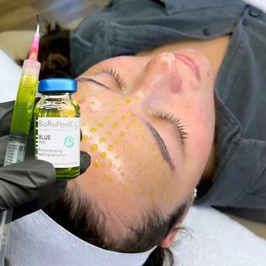 BioRePeel treatment at Dr Alexa, Mayfair London