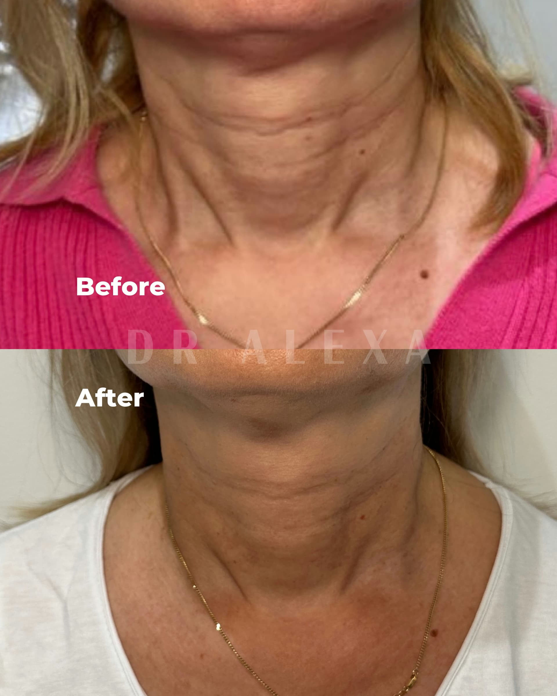 Biostimulators before and after — case 1, Dr Alexa Mayfair