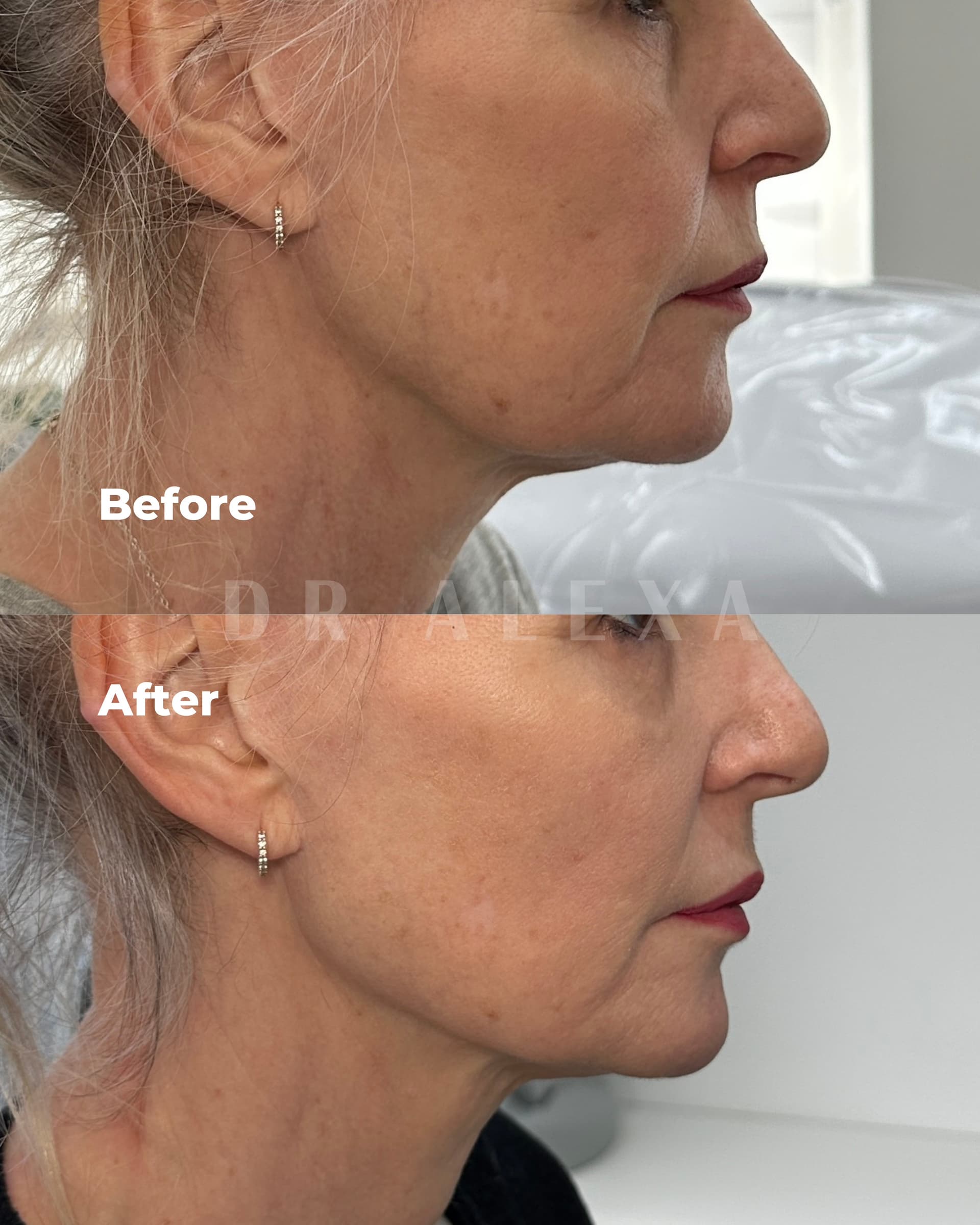 Biostimulators before and after — case 3, Dr Alexa Mayfair