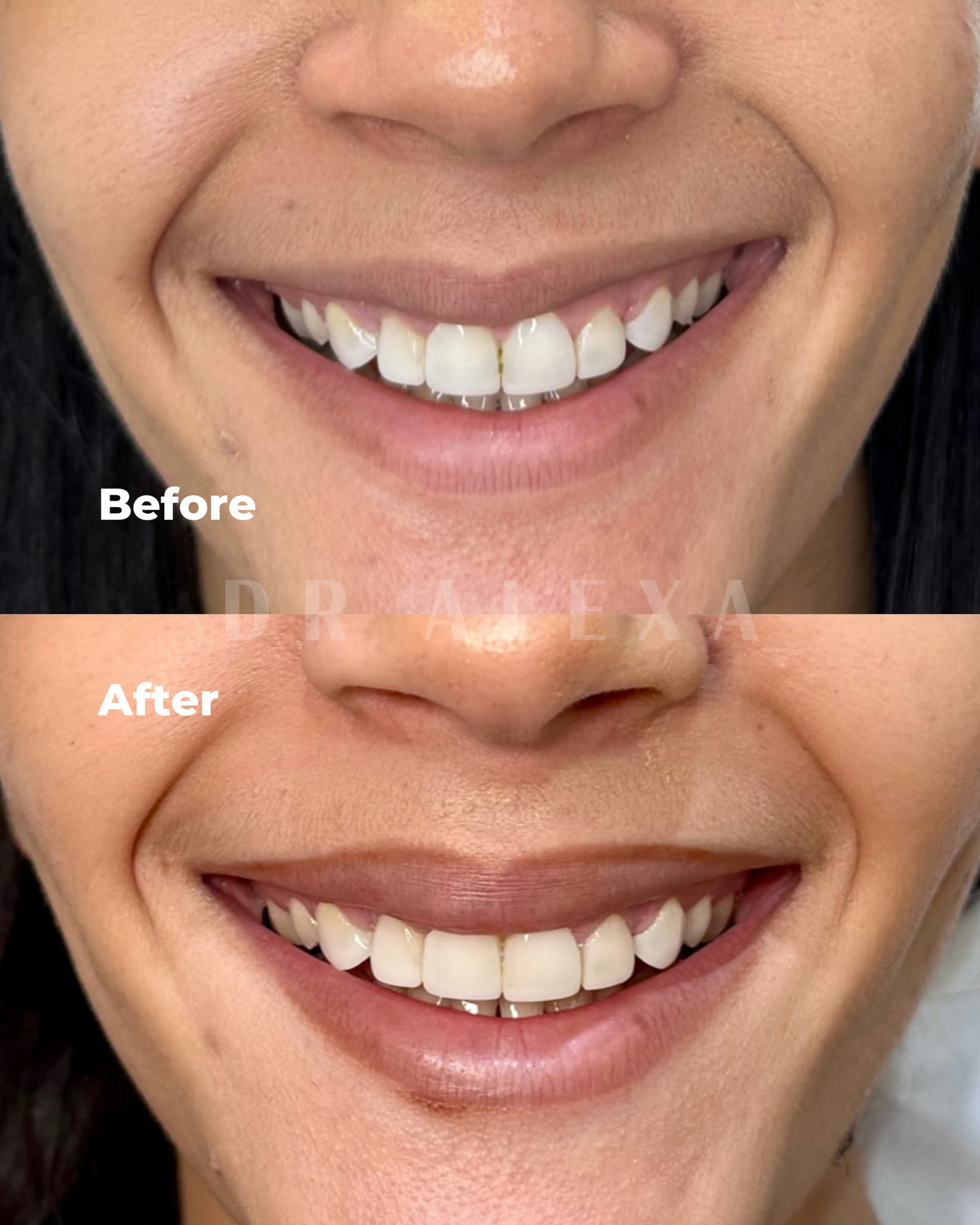 Lip Flip before and after — case 1, Dr Alexa Mayfair