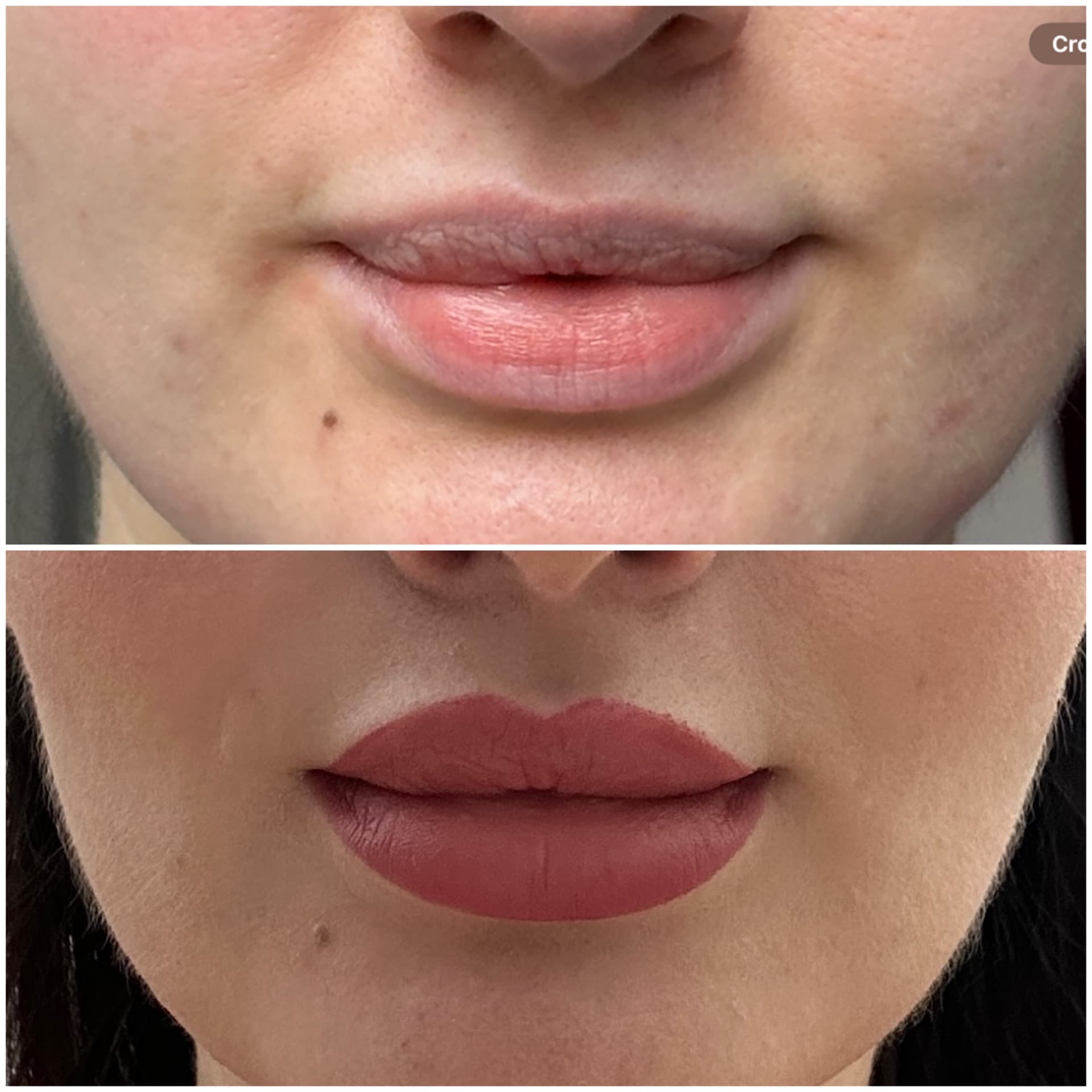Lip Flip before and after — case 2, Dr Alexa Mayfair