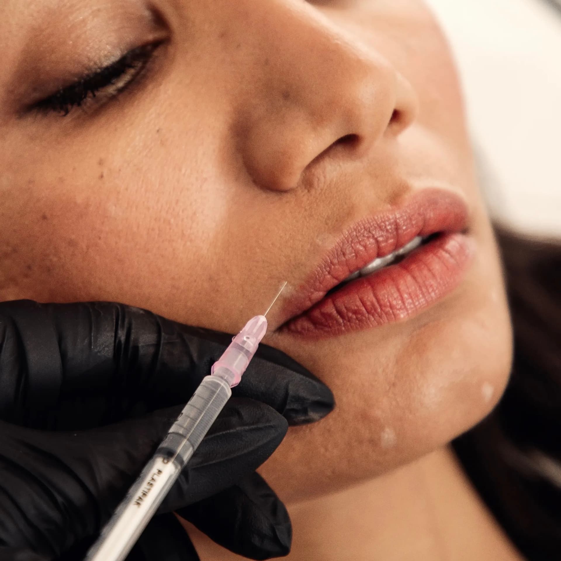 Lip Flip treatment at Dr Alexa, Mayfair London