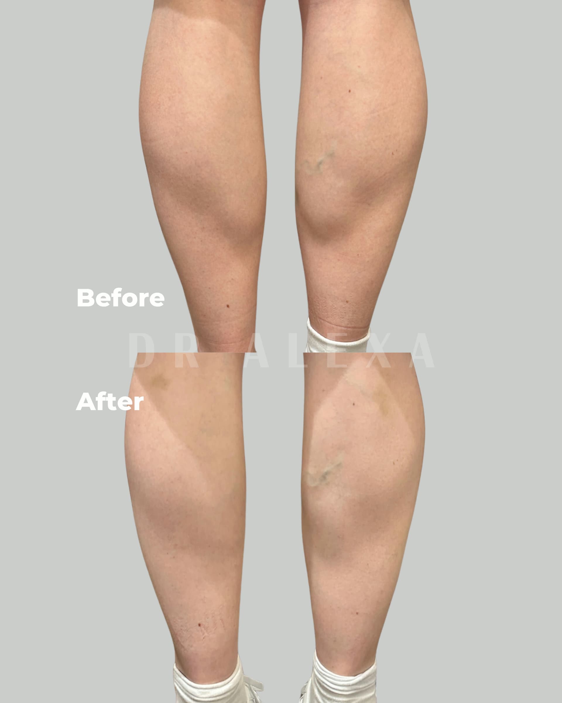 Calf Slimming before and after — case 1, Dr Alexa Mayfair