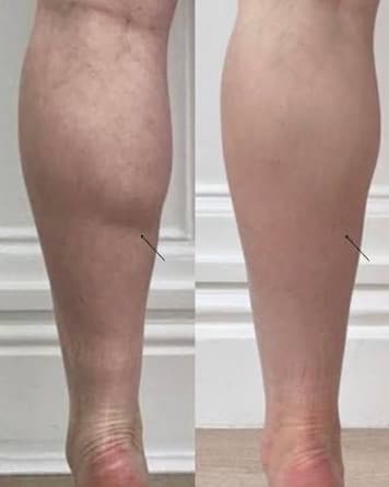 Calf Slimming before and after — case 2, Dr Alexa Mayfair