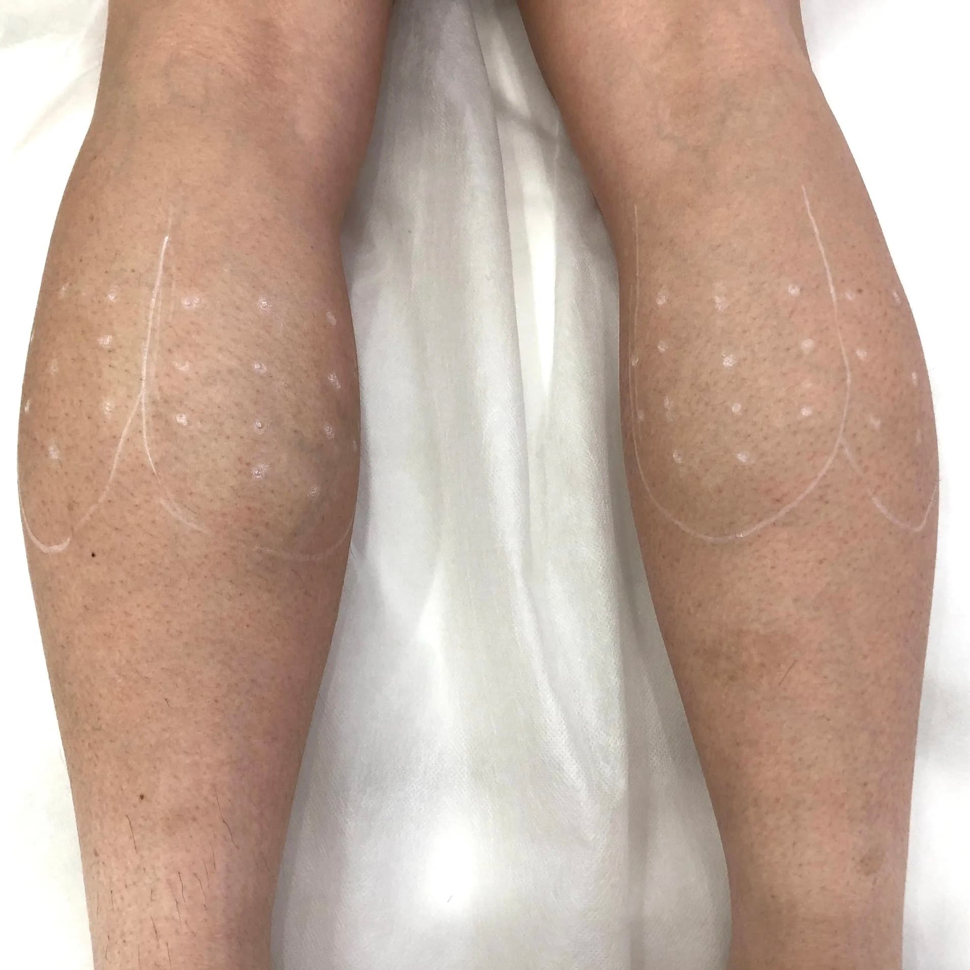 Calf Slimming treatment at Dr Alexa, Mayfair London