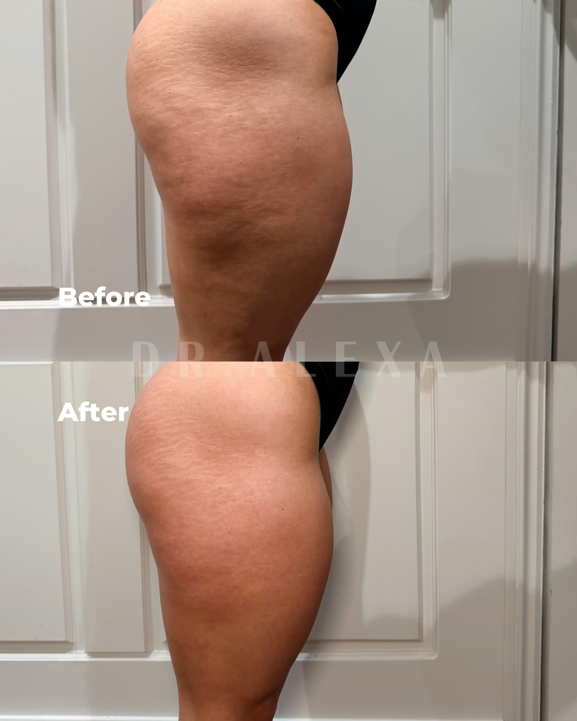 Cellulite Treatment before and after — case 1, Dr Alexa Mayfair