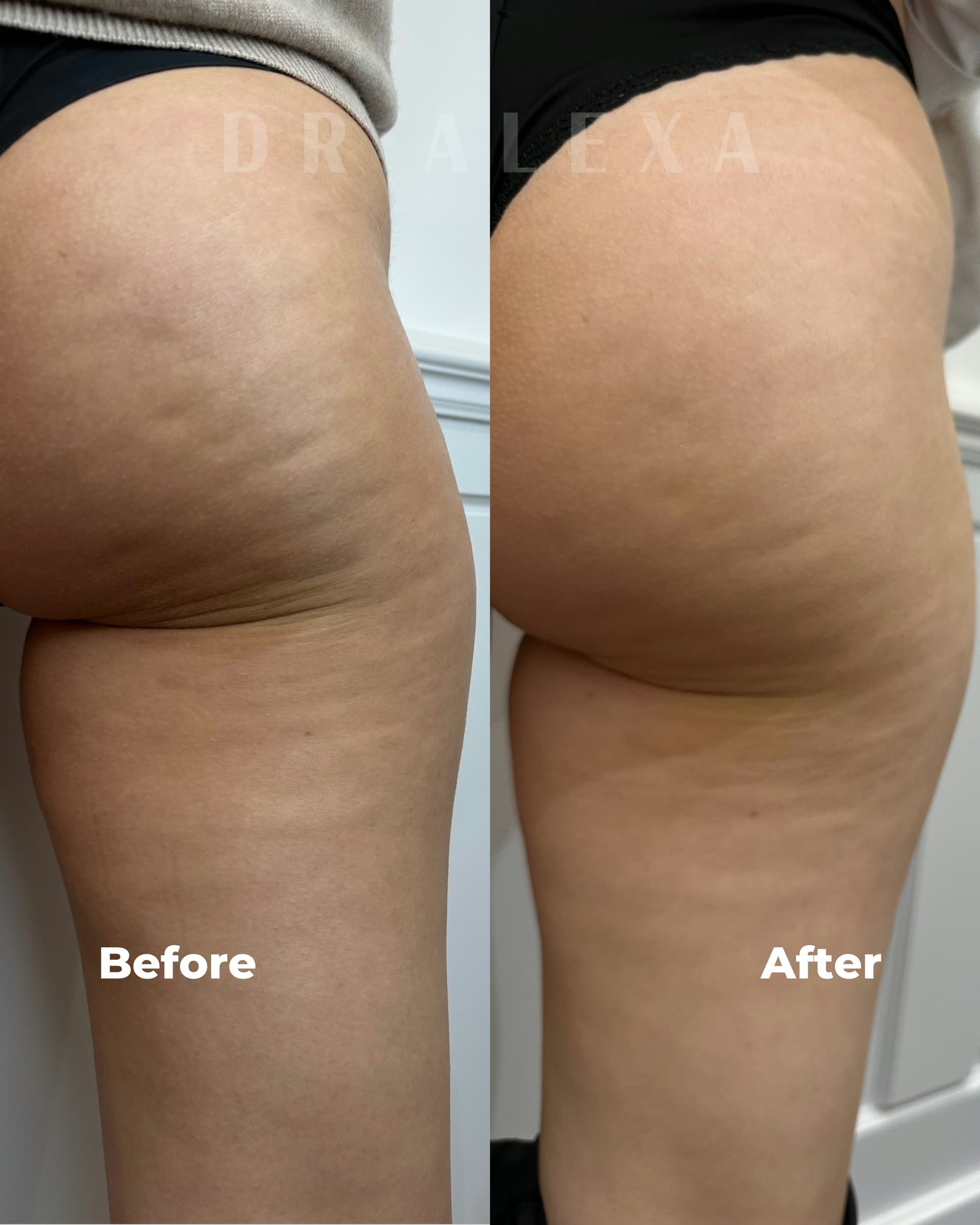 Cellulite Treatment before and after — case 2, Dr Alexa Mayfair