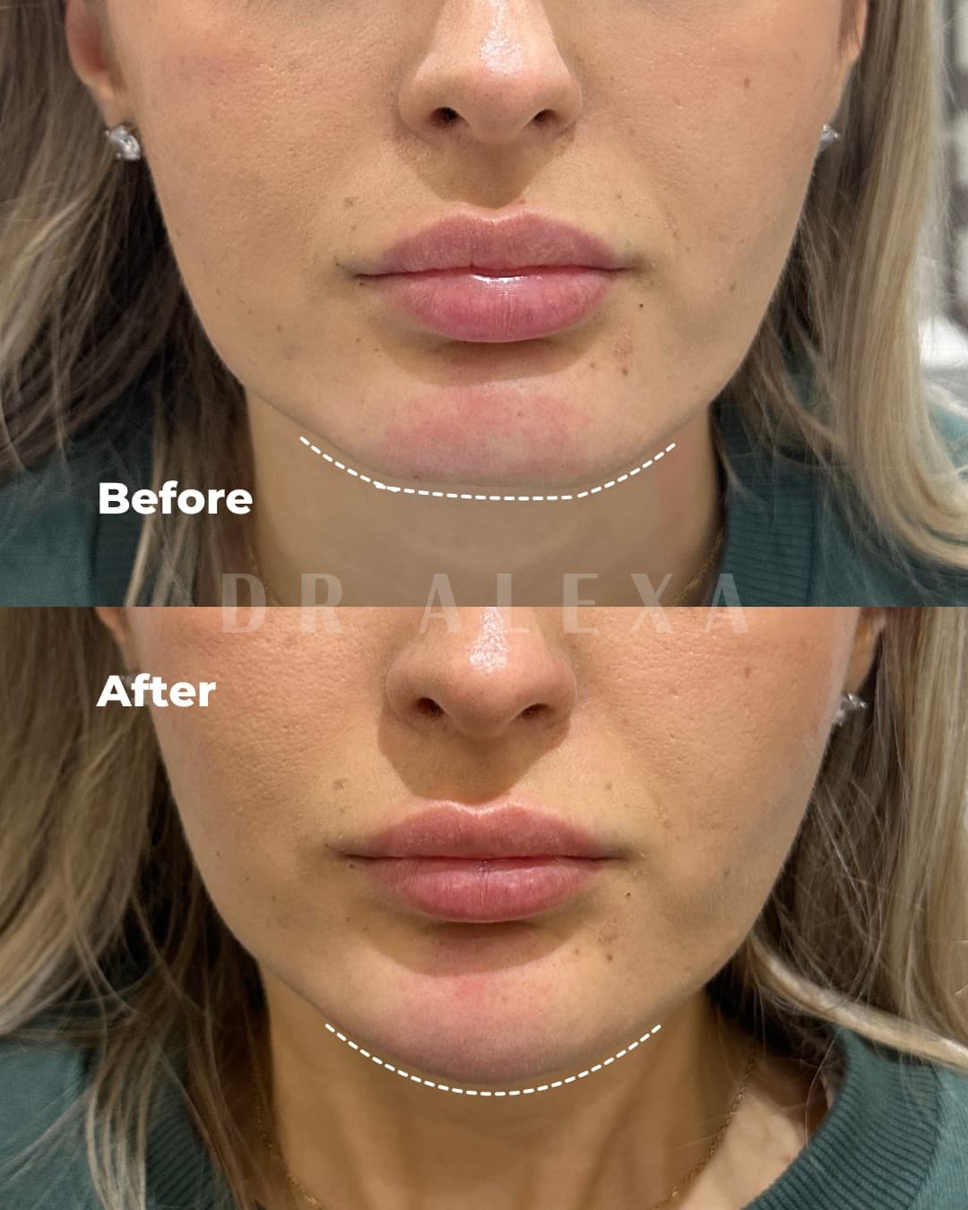 Chin Filler before and after — case 1, Dr Alexa Mayfair