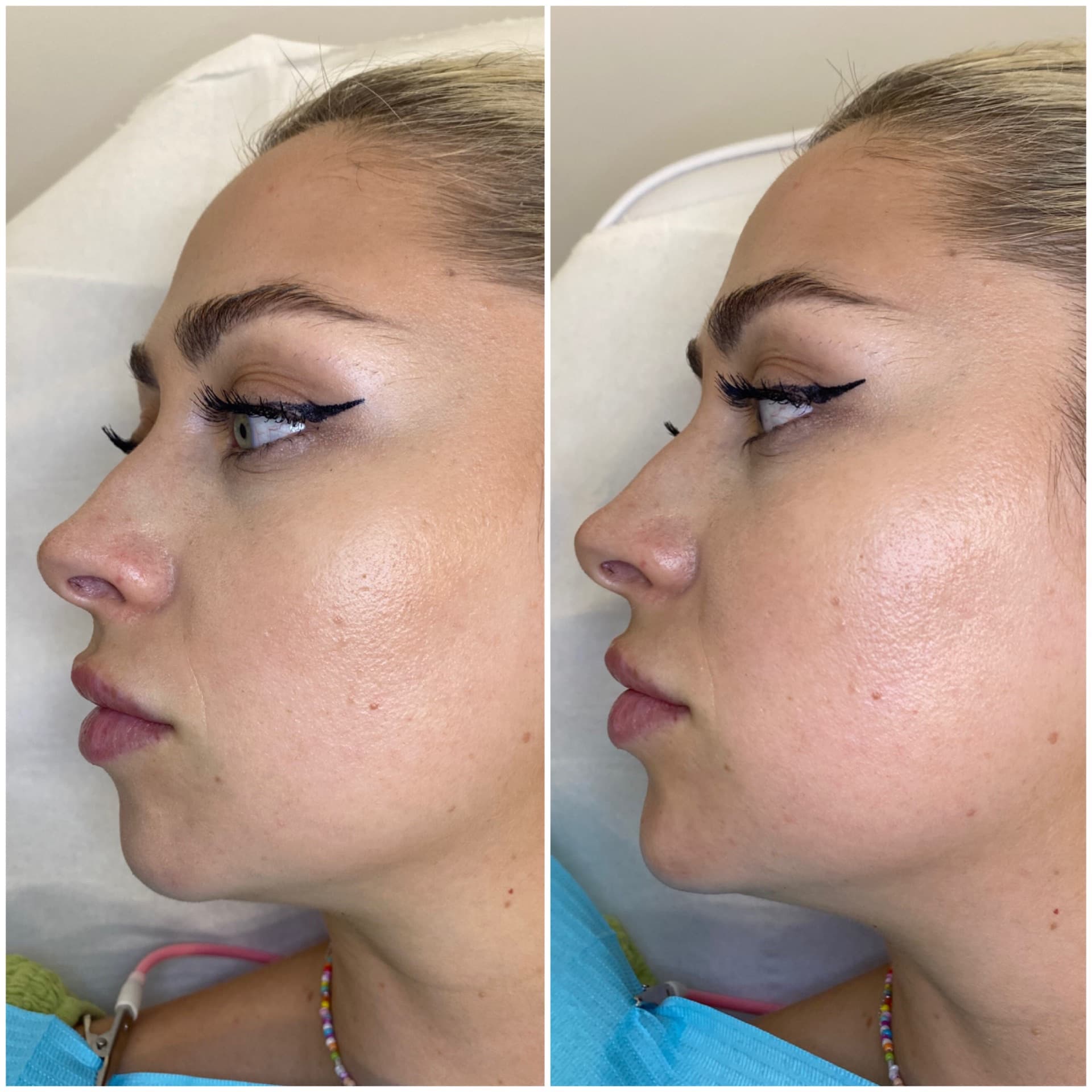 Chin Filler before and after — case 3, Dr Alexa Mayfair