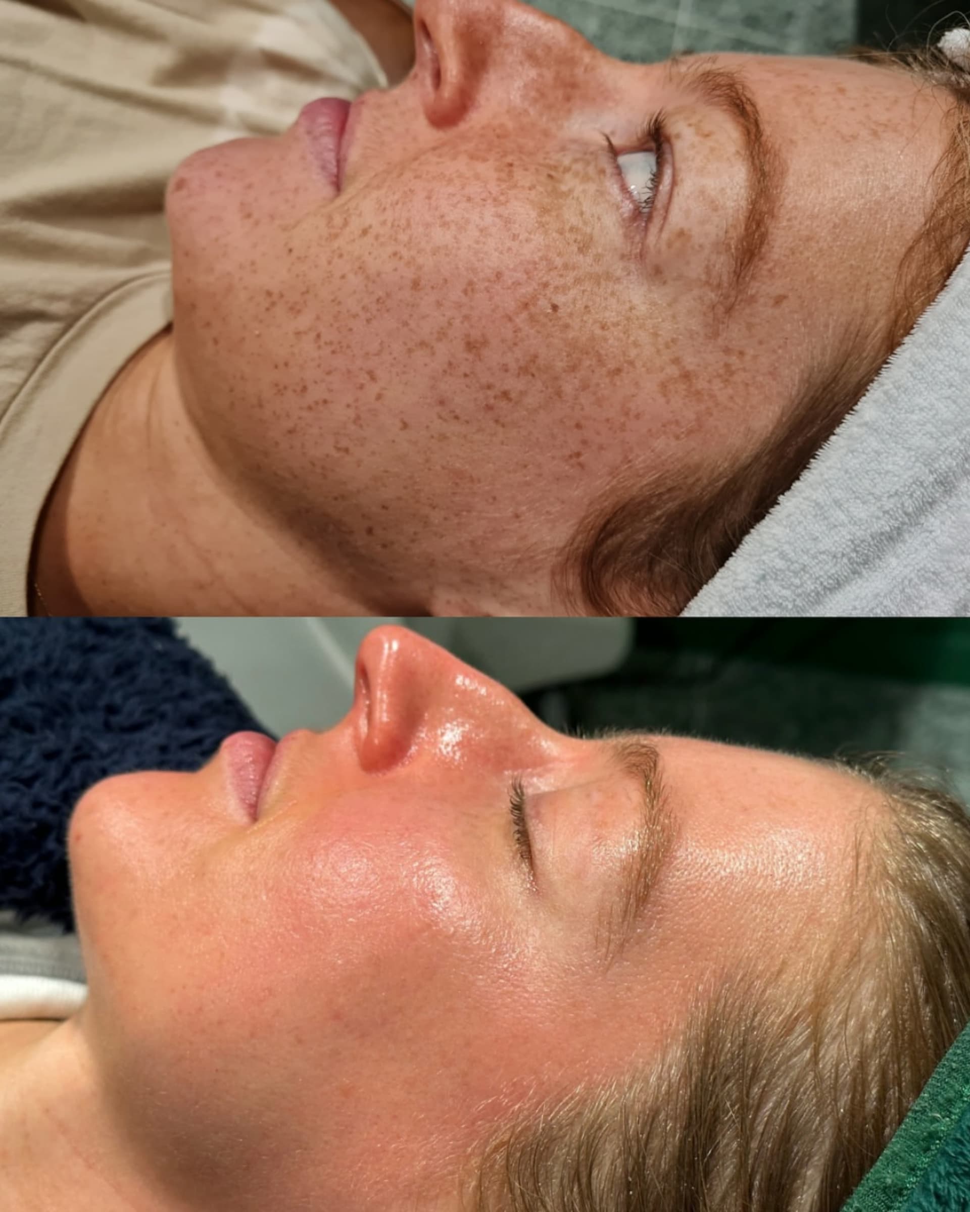 Cosmelan / Dermamelan before and after — case 1, Dr Alexa Mayfair