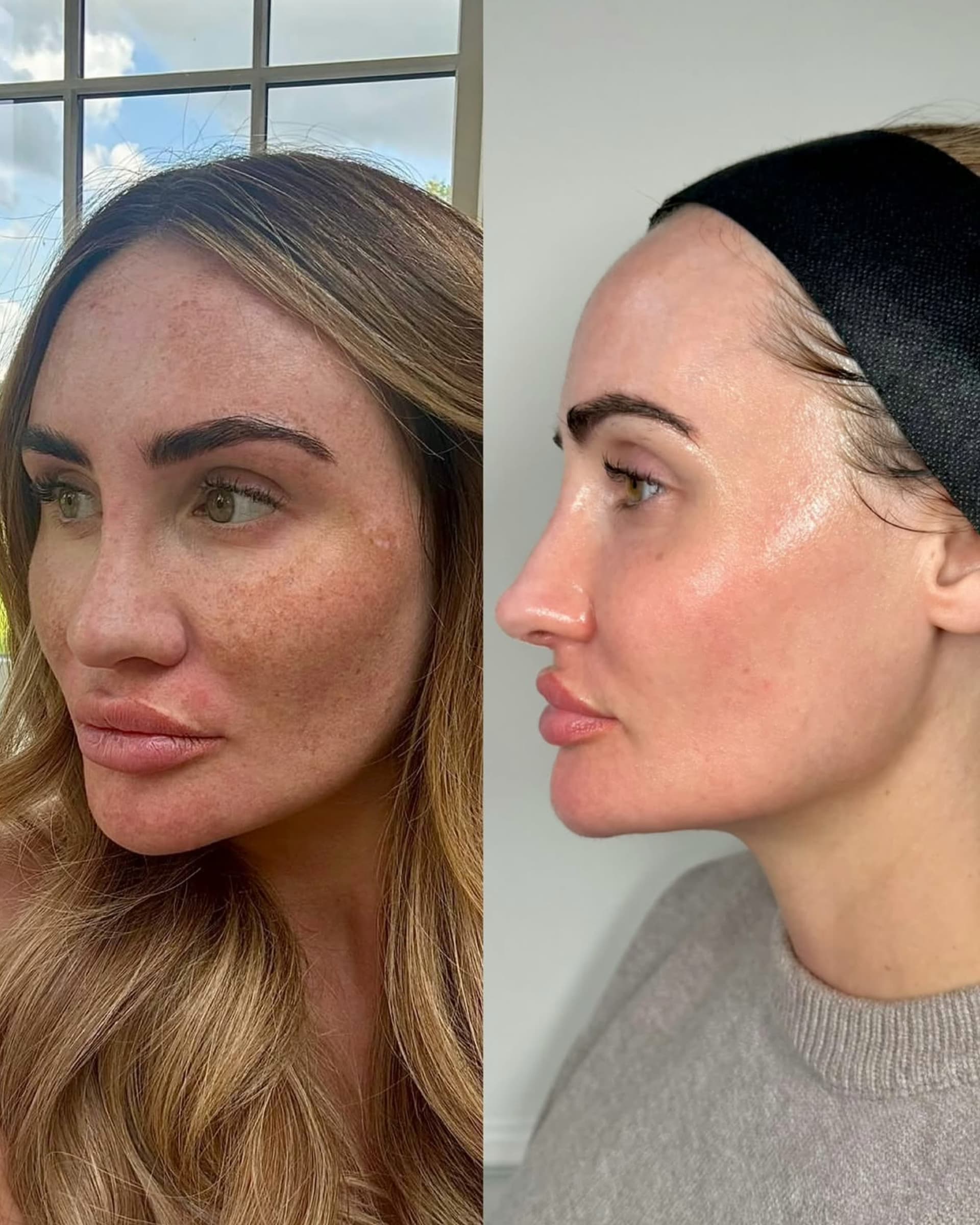 Cosmelan / Dermamelan before and after — case 2, Dr Alexa Mayfair