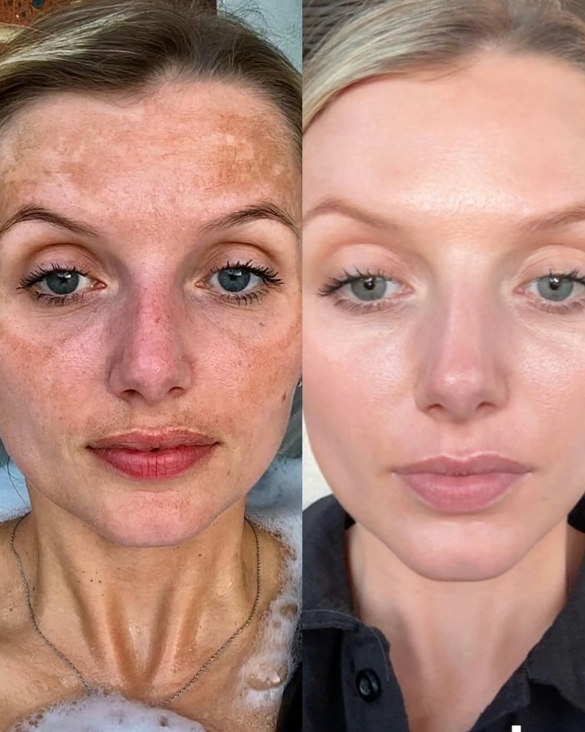 Cosmelan / Dermamelan before and after — case 3, Dr Alexa Mayfair
