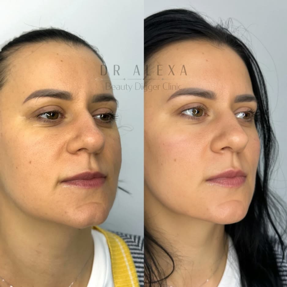 Dermal Fillers before and after — case 1, Dr Alexa Mayfair