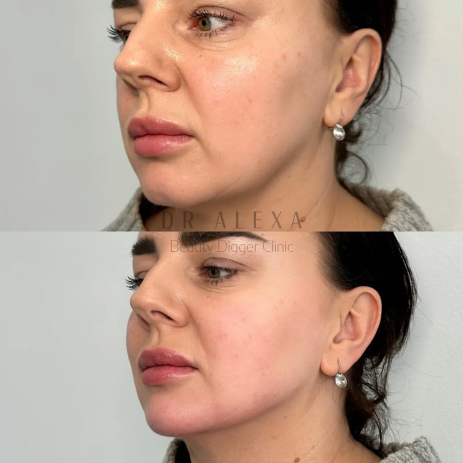 Dermal Fillers before and after — case 3, Dr Alexa Mayfair