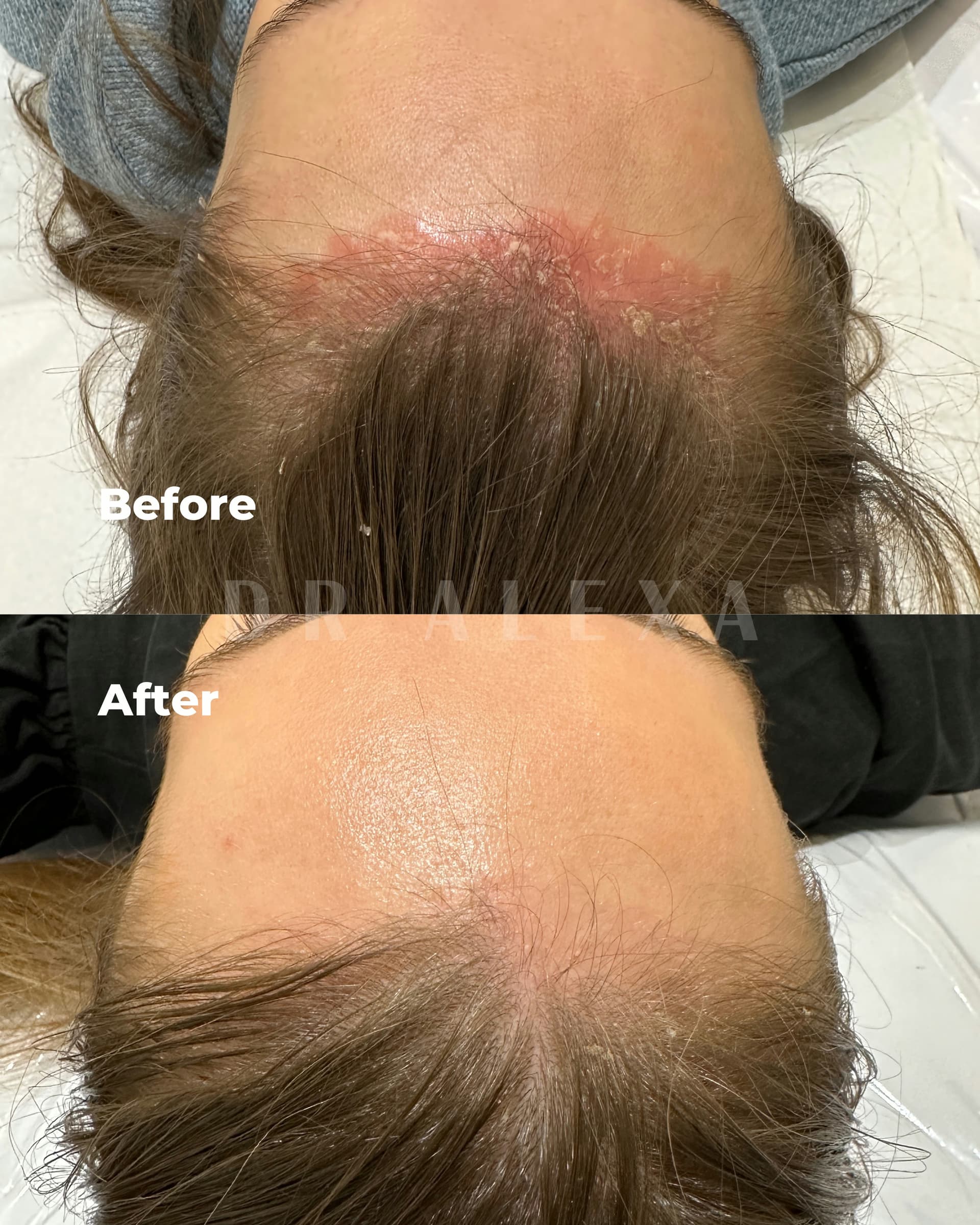 Dermalux LED Therapy before and after — case 1, Dr Alexa Mayfair