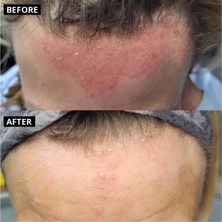 Dermalux LED Therapy before and after — case 2, Dr Alexa Mayfair