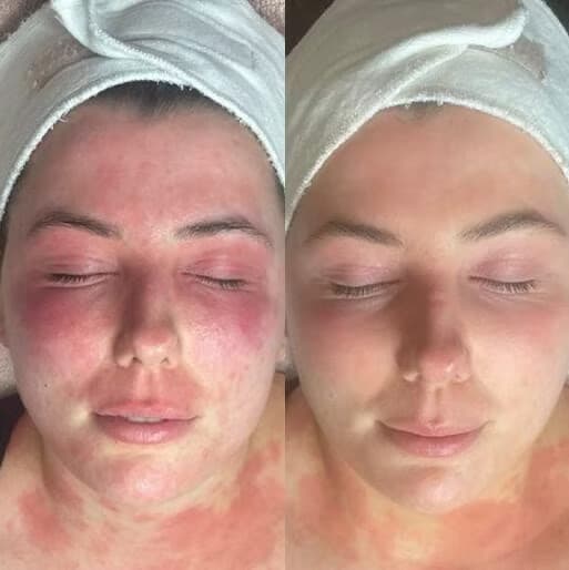 Dermalux LED Therapy before and after — case 3, Dr Alexa Mayfair