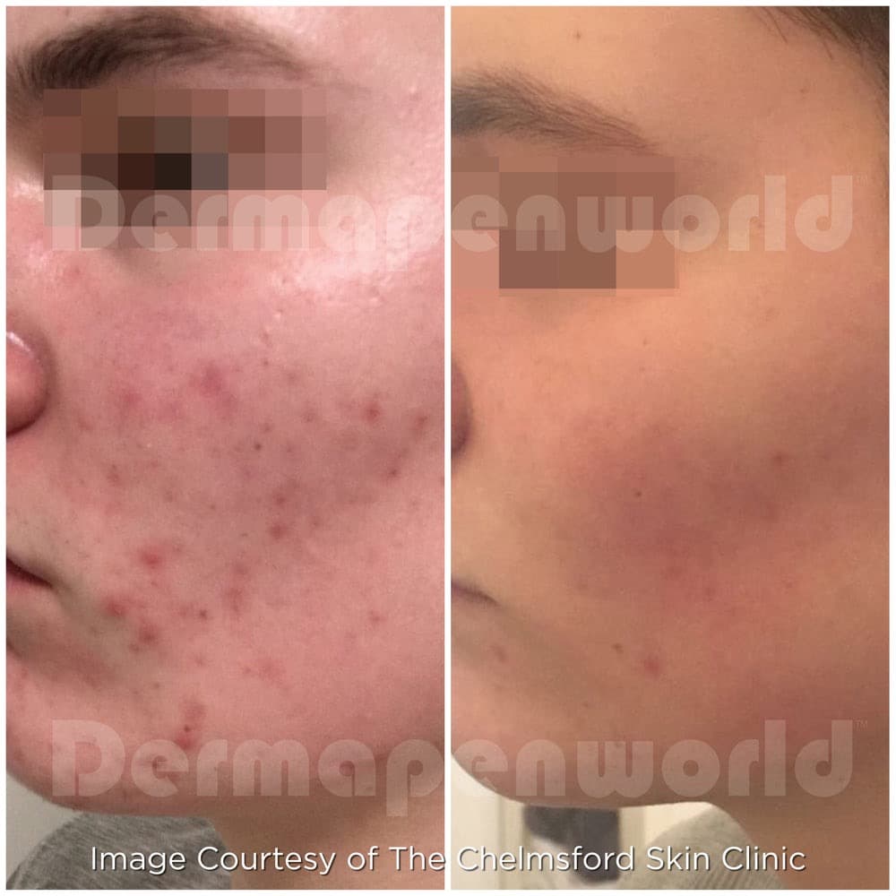 Dermapen Microneedling before and after — case 1, Dr Alexa Mayfair