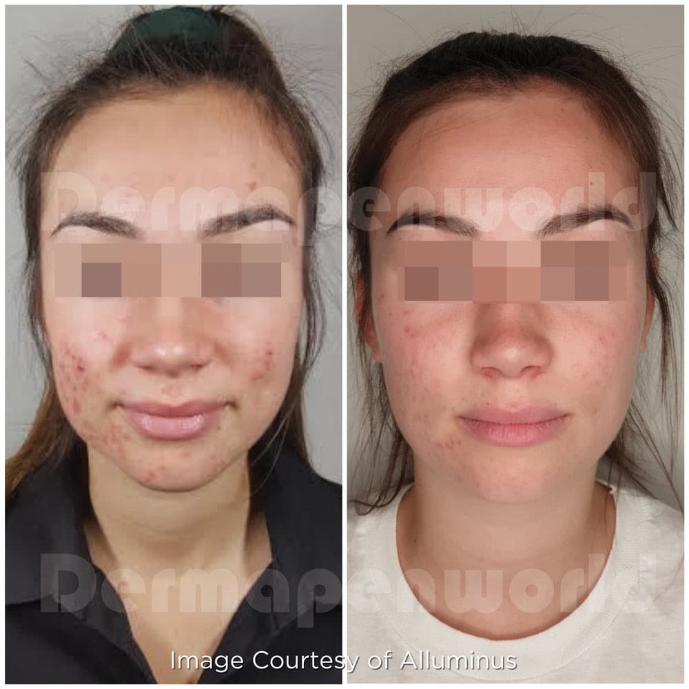Dermapen Microneedling before and after — case 2, Dr Alexa Mayfair