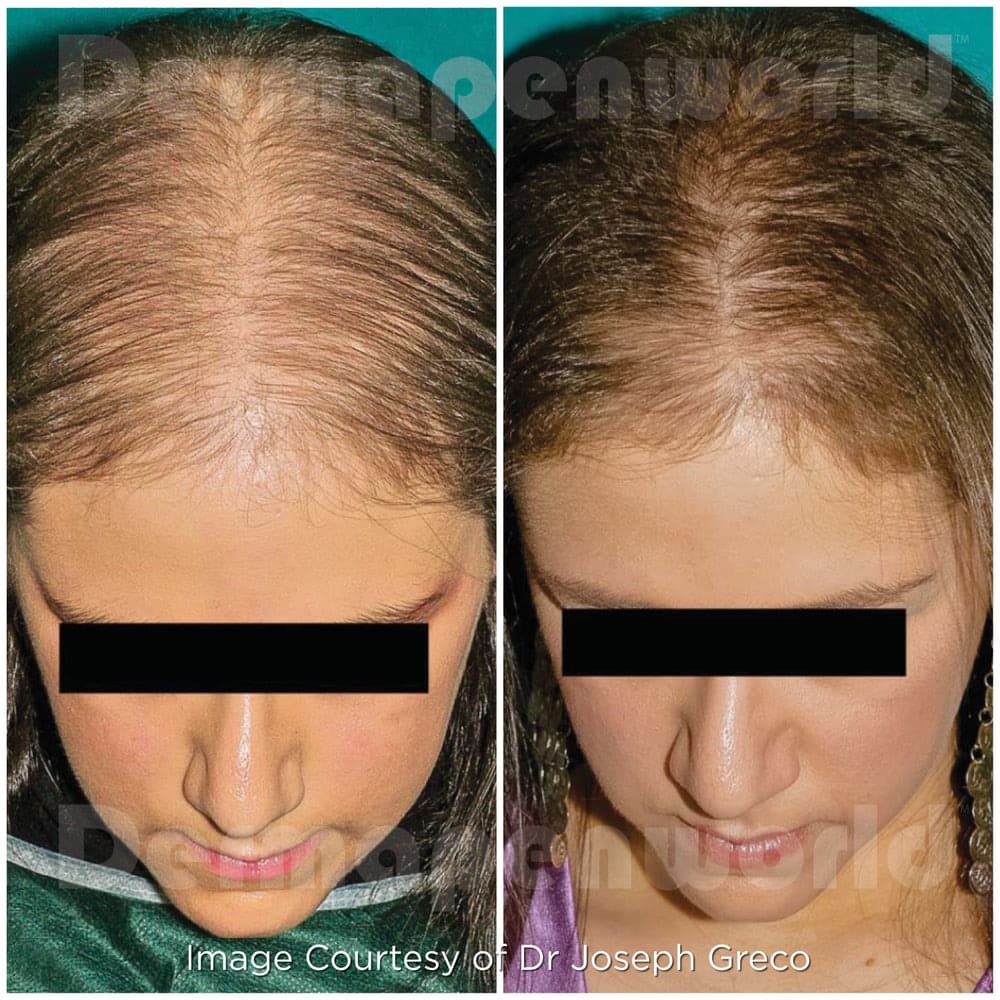 Dermapen Microneedling before and after — case 3, Dr Alexa Mayfair