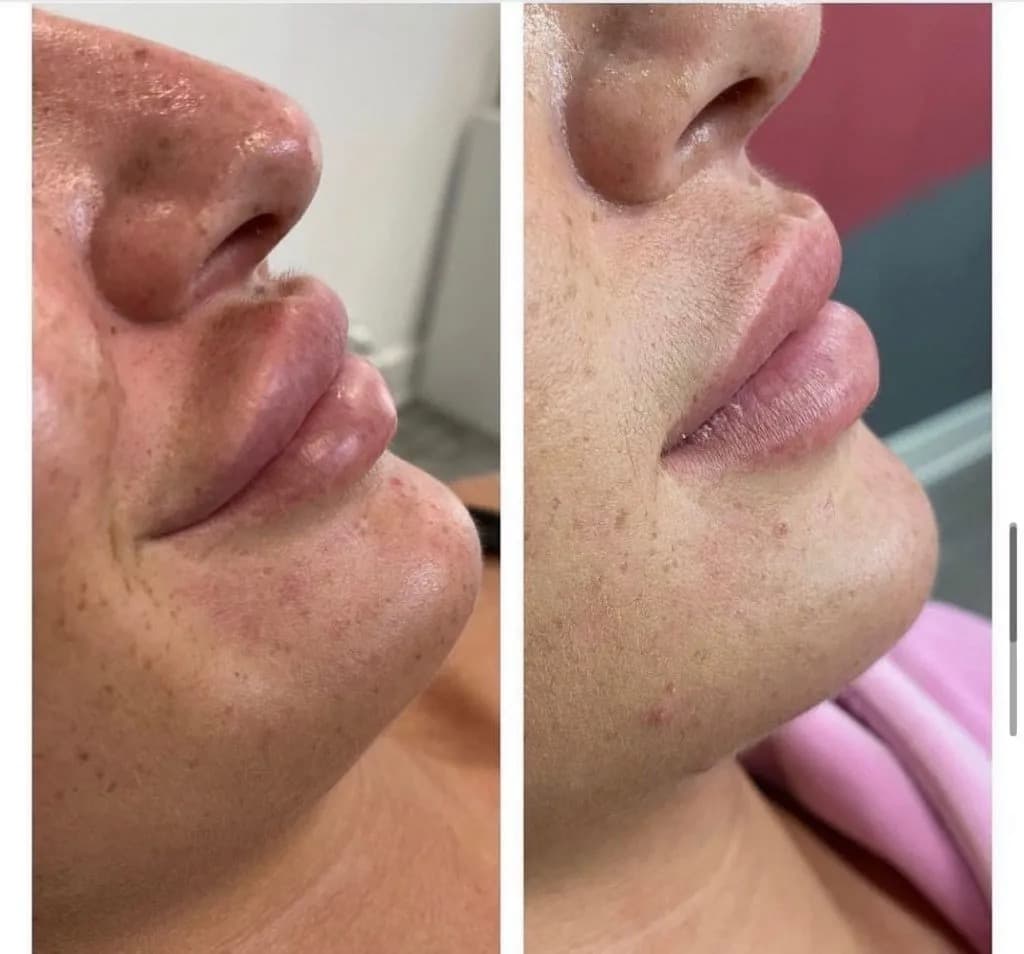 Filler Dissolving before and after — case 1, Dr Alexa Mayfair