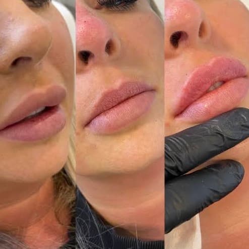 Filler Dissolving before and after — case 2, Dr Alexa Mayfair