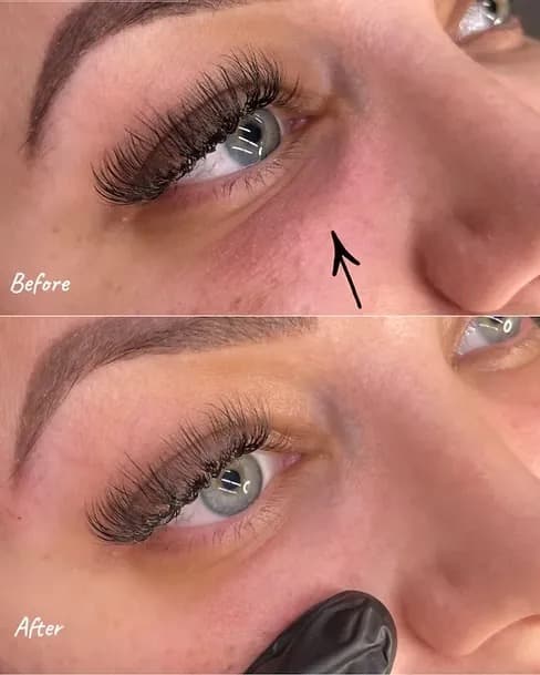 Filler Dissolving before and after — case 3, Dr Alexa Mayfair