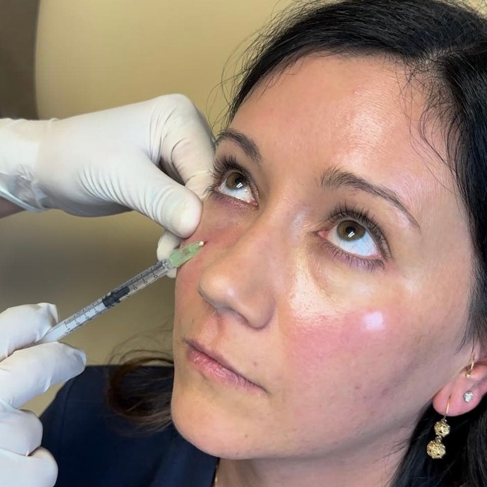 Filler Dissolving treatment at Dr Alexa, Mayfair London