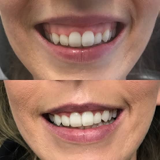 Gummy Smile before and after — case 1, Dr Alexa Mayfair
