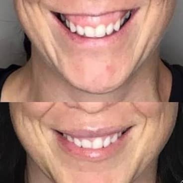 Gummy Smile before and after — case 2, Dr Alexa Mayfair