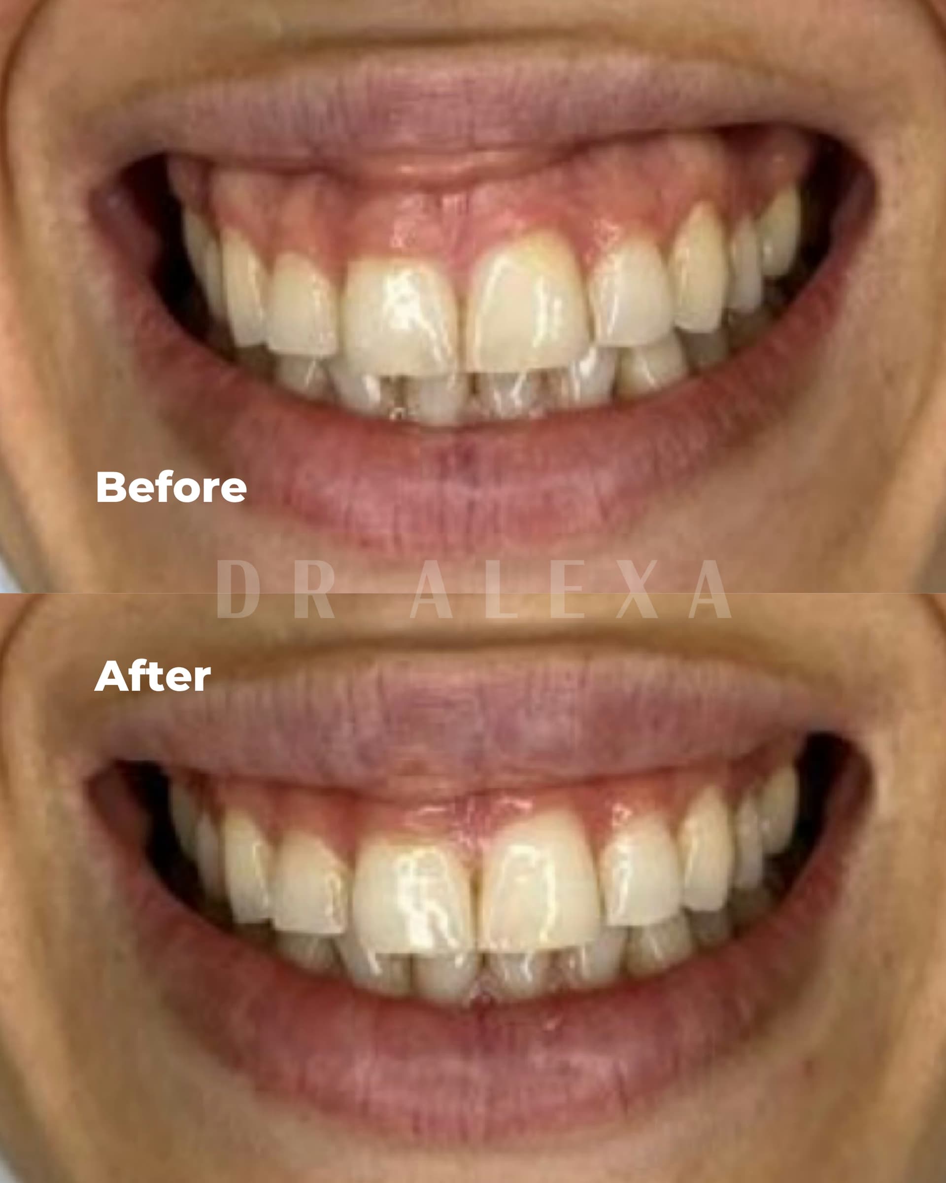 Gummy Smile before and after — case 3, Dr Alexa Mayfair